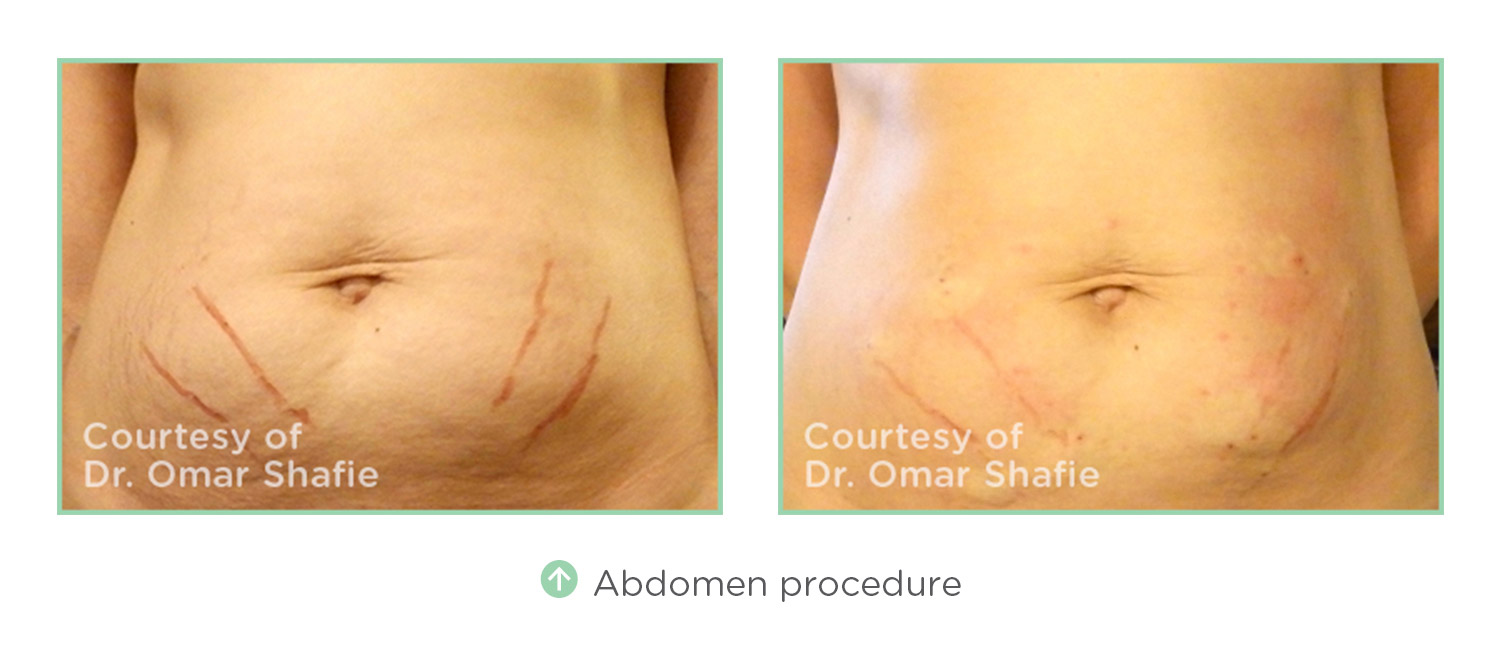 NovaThreads Abdomen, Before and After