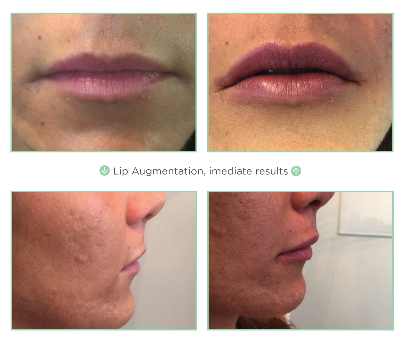 NovaThreads Lips, Before and After