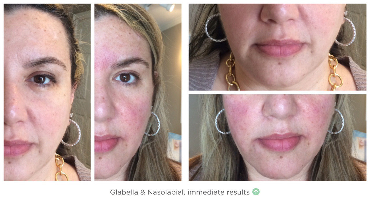 NovaThreads Glabella and Nasolabia, Before and After