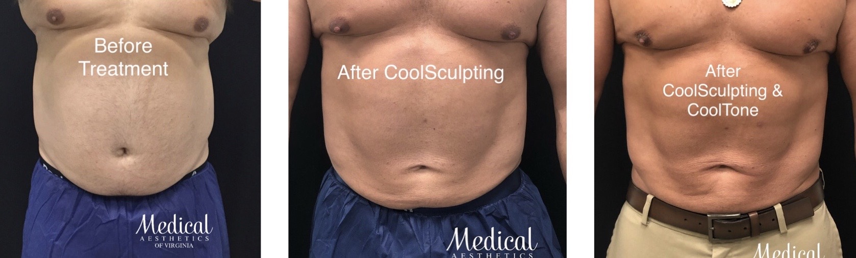 Is CoolSculpting Right for You? How Much Does Coolsculpting Cost